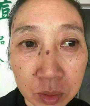 去老年斑的簡單方法，重拾肌膚光彩的秘訣，去老年斑秘籍，重拾肌膚光彩的簡易方法