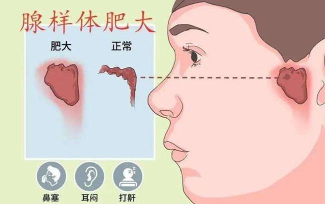 腺樣體肥大能自愈嗎？——深度解析與理解，腺樣體肥大能否自愈？全面深度解析