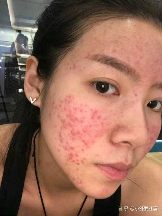 如何有效去除臉上的痘印——全方位指南，全方位指南，如何有效去除臉上痘印的方法