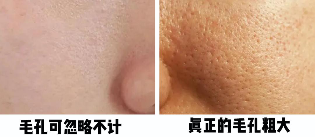 怎樣毛孔可以慢慢縮小，護膚秘籍與實用建議，護膚秘籍，縮小毛孔實用建議與指南