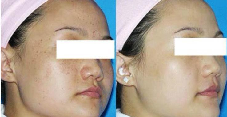 激光祛斑后需要注意的五大事項(xiàng)，激光祛斑后的五大注意事項(xiàng)詳解