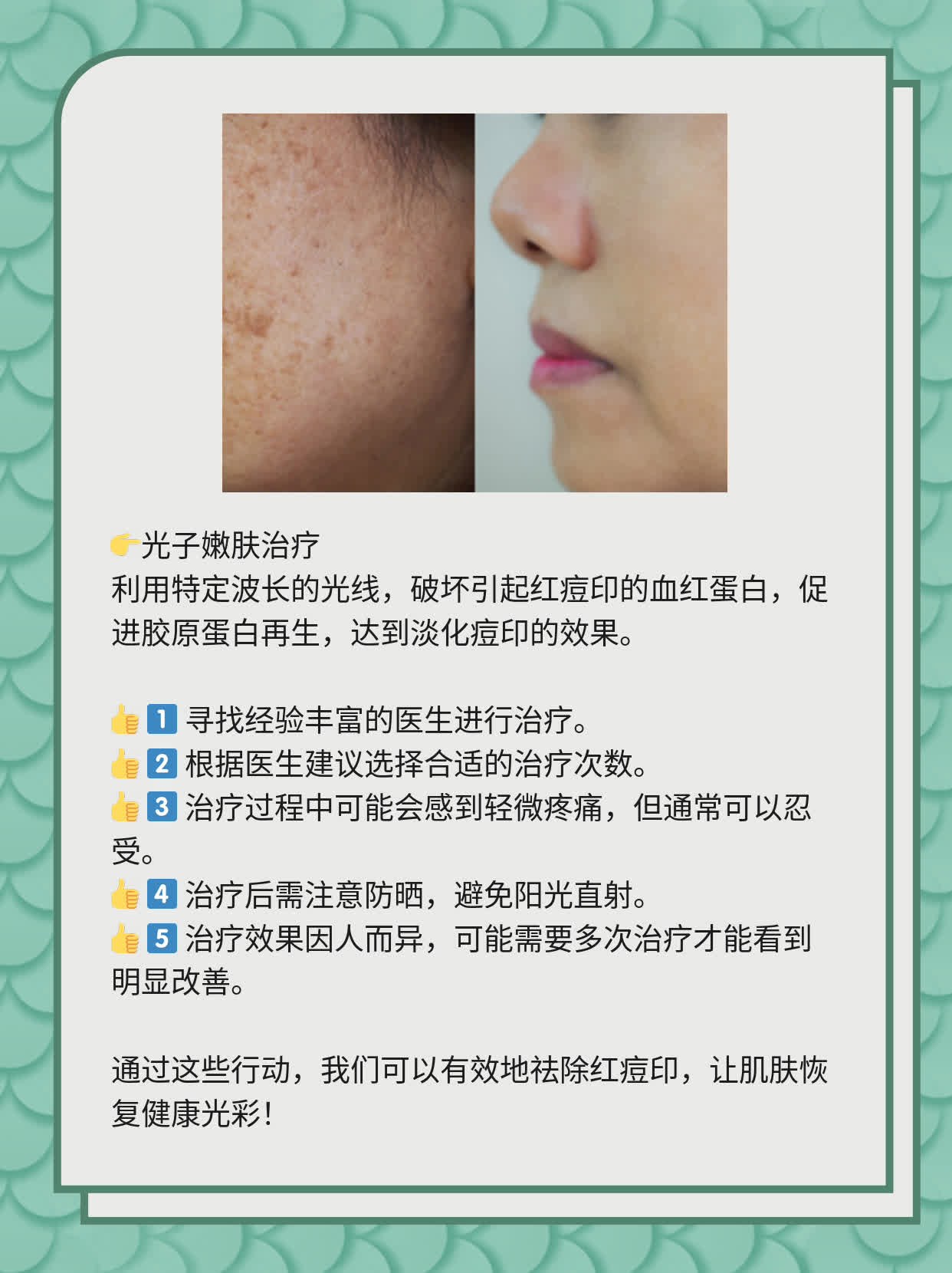 如何有效去除紅痘印，一站式解決方案，一站式解決紅痘印問題，有效去除方法大全