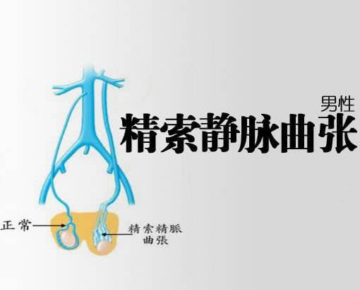 精索靜脈曲張的癥狀表現(xiàn)及其影響，精索靜脈曲張的癥狀表現(xiàn)及其潛在影響