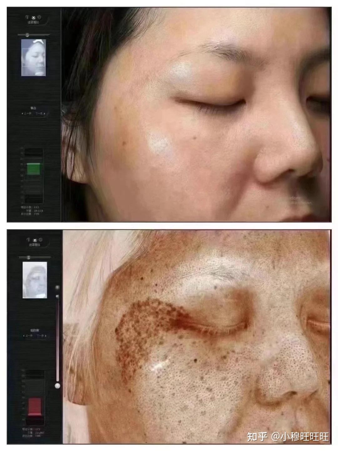激光祛斑，選擇醫(yī)院還是美容院？全面解讀助您做出明智決策，激光祛斑，如何選擇醫(yī)院與美容院？全面解讀為您指明決策方向