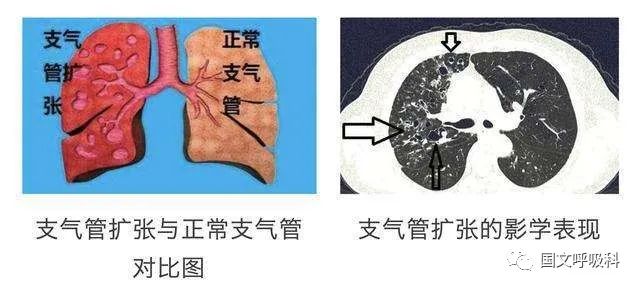 支氣管擴(kuò)張，了解、預(yù)防與應(yīng)對，支氣管擴(kuò)張，全面解析、預(yù)防與應(yīng)對策略