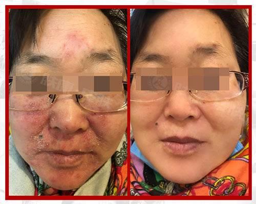 臉部過敏如何迅速消除，全面指南，臉部過敏迅速消除全面指南