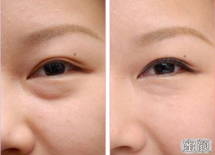 如何消除眼袋，簡單實(shí)用的方法，消除眼袋的實(shí)用方法與技巧